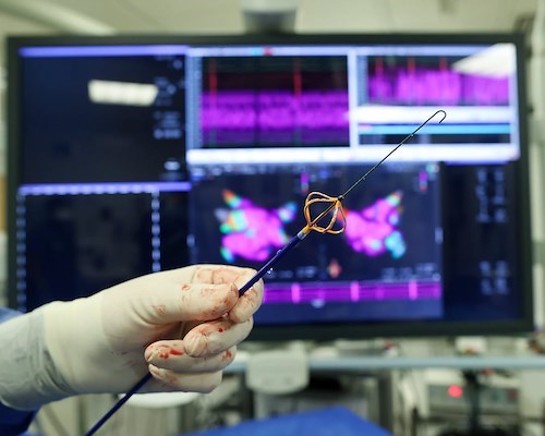 Nuova speranza per i pazienti cardiopatici: a Benevento eseguite per la prima volta due ablazioni a "campo pulsato"